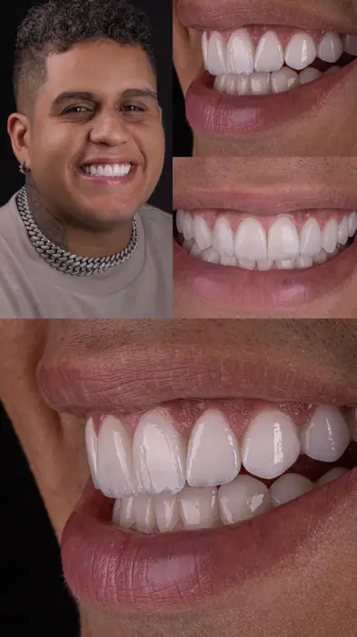 Resultado real 3 - sorriso transformado pela Clínica Viotto