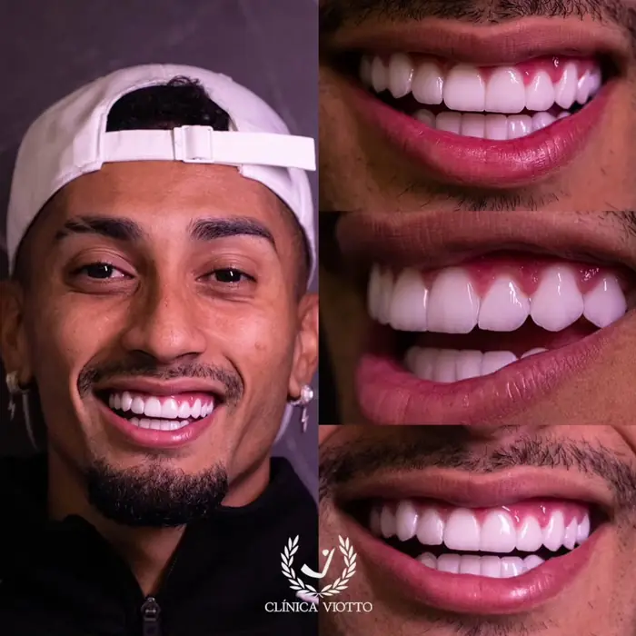 Resultado real 4 - sorriso transformado pela Clínica Viotto