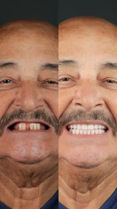 Caso de implante 3 - antes e depois