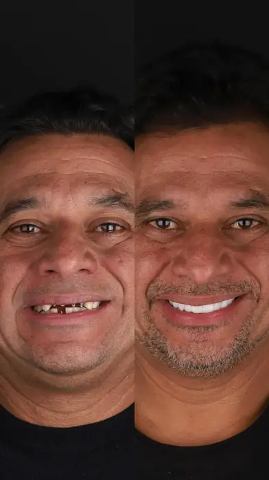 Caso de implante 5 - antes e depois