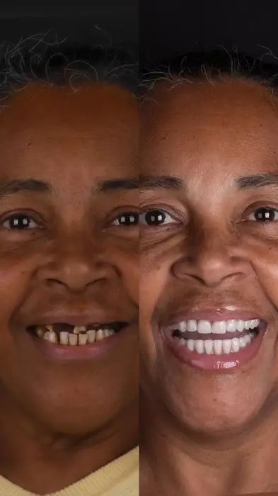 Caso de implante 6 - antes e depois