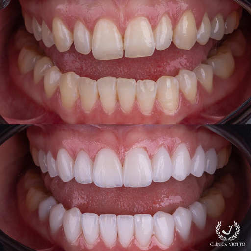 Clareamento Dental Rápido