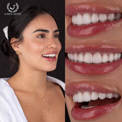 facetas dentárias antes e depois