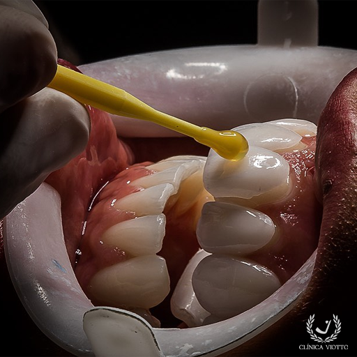 Lentes de Contato Dental Viotto Especializadas